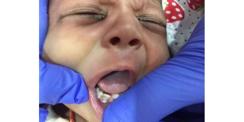 بھارت میں ایک ماہ کے بچے کے 7 دانتوں کا کامیاب آپریشن