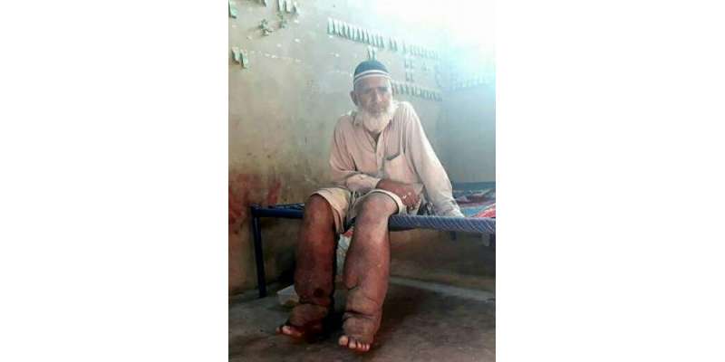 ٹانگیں پھول کر غبارہ ہو گئیں،جلد کی پر اسرار بیماری میں مبتلا کراچی ..