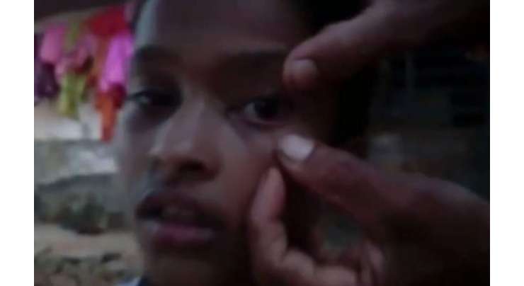بھارتی لڑکی کی آنکھوں سے ہر روز  چیونٹیاں نکلنے لگیں۔ کوئی اس کی وجہ نہیں جانتا