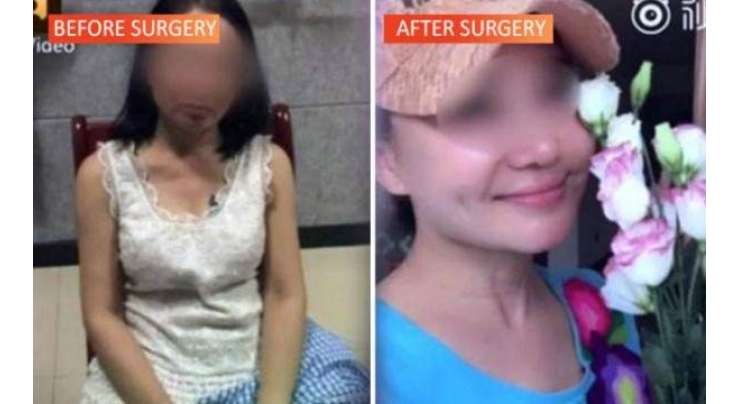قرض داروں سے بچنے کے لیے 60 سالہ خاتون پلاسٹک سرجری کر ا کر  20 کی دہائی کی لڑکی  لگنے لگی
