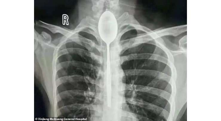 ایک شخص کی غذا کی نالی میں 1 سال سے موجود 8 انچ کے دھاتی چمچ کو نکال دیا گیا