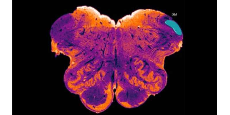 سائنسدانوں نے پہلی بار دماغ کا چھپا ہوا حصہ دریافت کرلیا