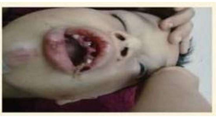 سعودی نوجوان نے غیر مُلکی بچے کے دانت توڑ ڈالے