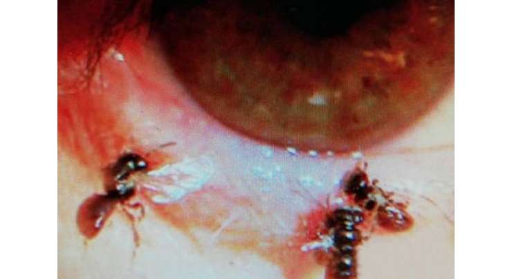 ڈاکٹروں  نے خاتون کی آنکھوں  میں سے  آنسوؤں پر پلنے والی چار  زندہ مکھیاں نکال لیں