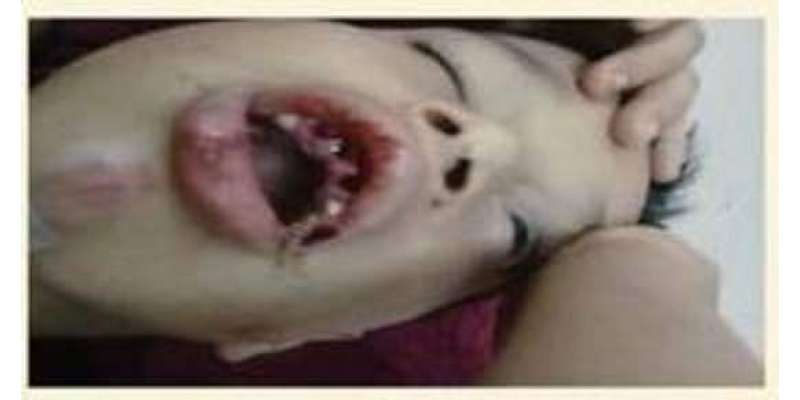 سعودی نوجوان نے غیر مُلکی بچے کے دانت توڑ ڈالے