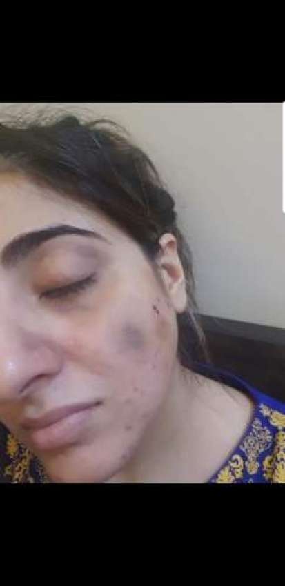 فاطمہ سہیل پر مبینہ تشدد کے بعد کی تصاویر