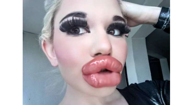بلغارین خاتون نے اپنے ہونٹ قدرتی سائز سے 4 گنا زیادہ موٹے کر لیے