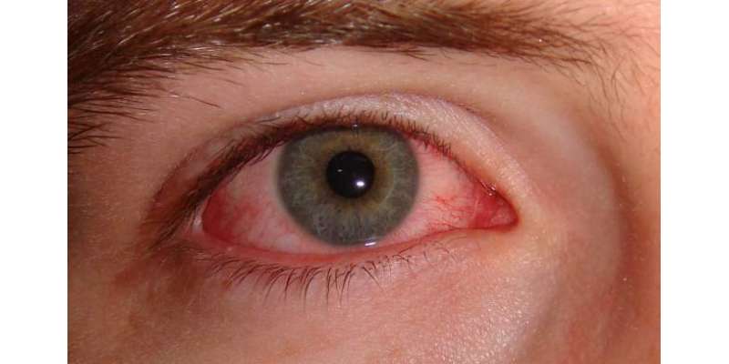 آنکھوں کا سرخ ہونا بھی کرونا وائرس کی علامت ہے