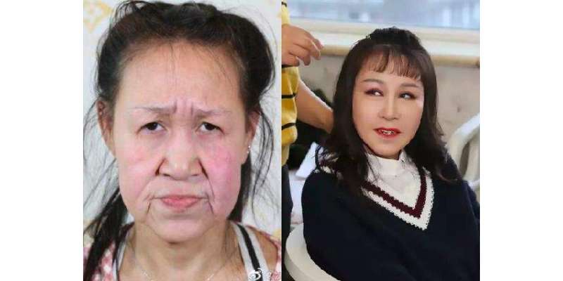 پلاسٹک سرجری سے  60 سال کی بوڑھی نظر آنے والی لڑکی پھر 15 سال کی لگنے لگی