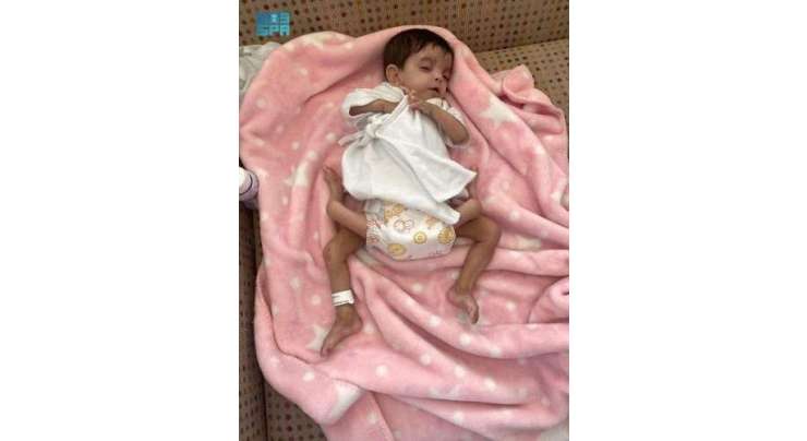 سعودی عرب میں جسمانی طور پر جڑے یمنی بچوں کو الگ کرنے کا آپریشن کامیاب ہو گیا