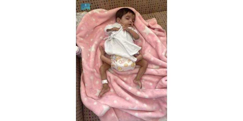 سعودی عرب میں جسمانی طور پر جڑے یمنی بچوں کو الگ کرنے کا آپریشن کامیاب ..