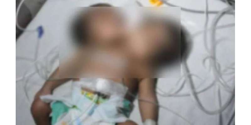 بھارت،2 سروں والے بچے کی پیدائش ، والدین ہسپتال سے فرار ہوگئے