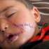 اسرائیلی بمباری میں ننھا بچہ زخمی، چہرے پر 200 ٹانکے لگے