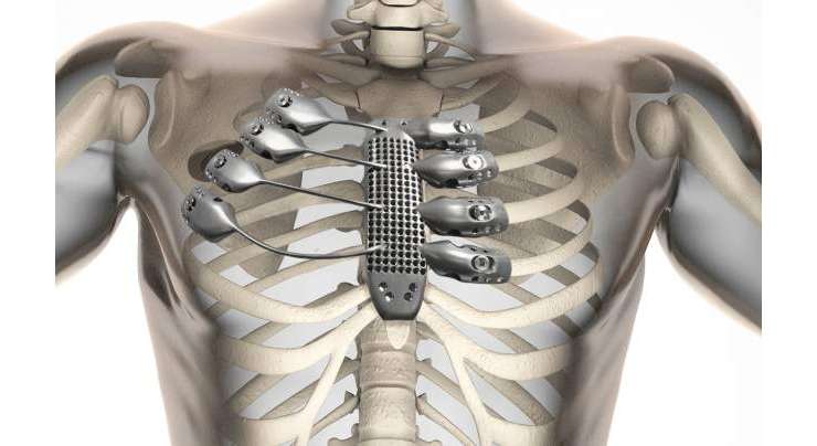 Spanish Cancer Patient Gets A 3D-printed Titanium Rib Cage